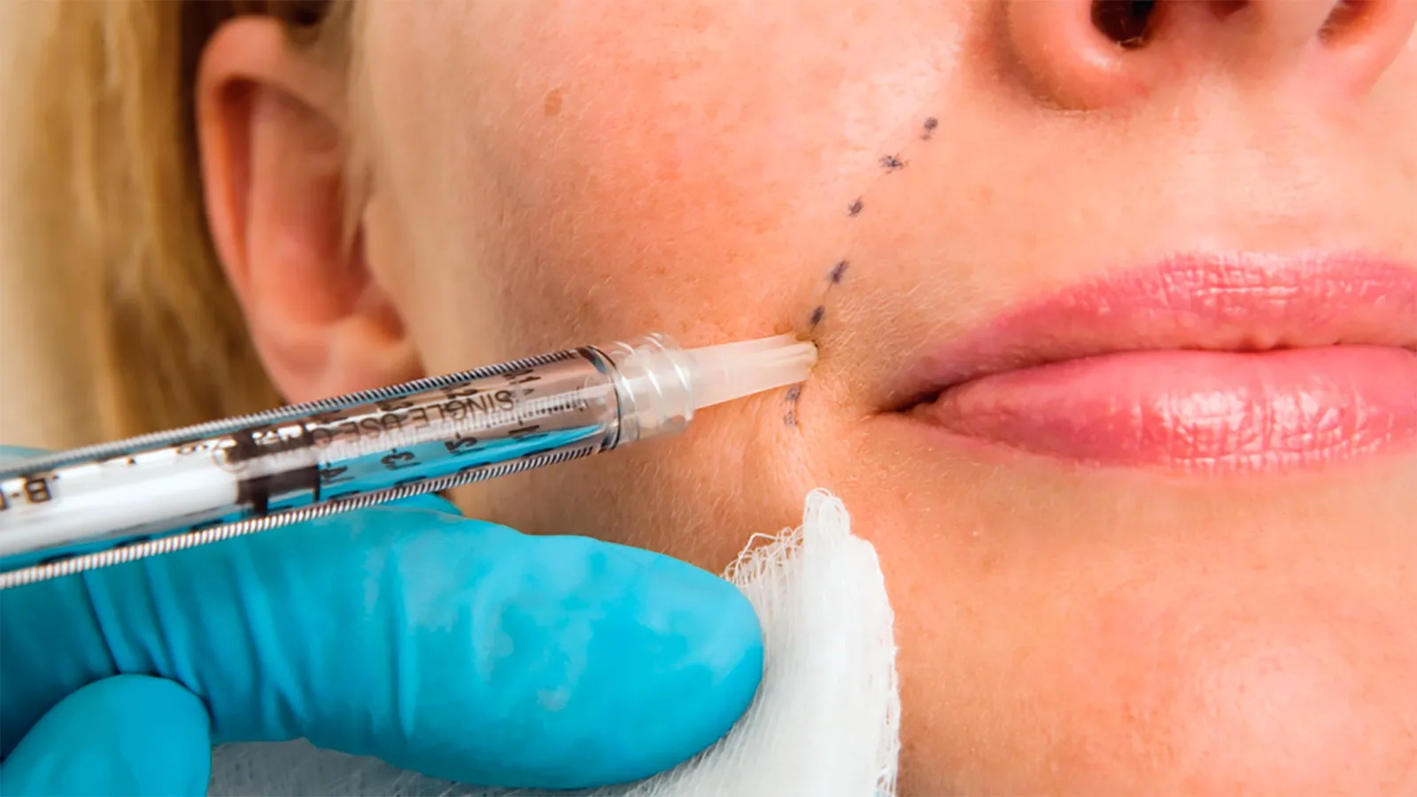 Dermal Filler Treatments Plantation, FL